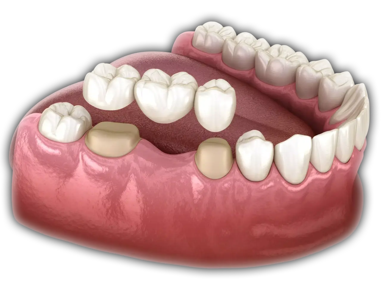 Dental Bridge 5 - All On Smile Dental Implants Vancouver WA