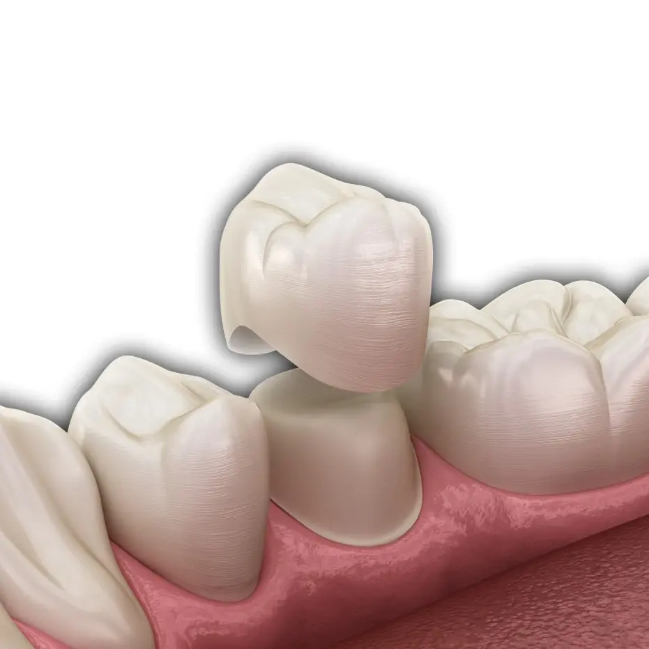 Dental Crown 2 - All On Smile Dental Implants Vancouver WA