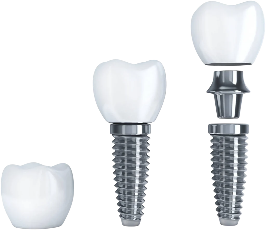Dental implant procedure at All On Smile Vancouver WA