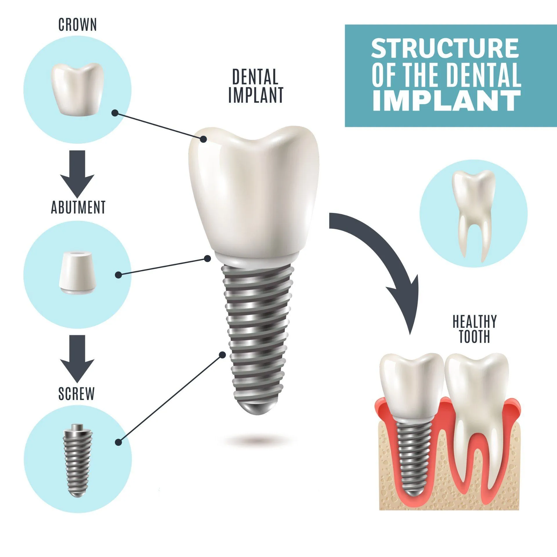 Dental implant procedure at All On Smile Vancouver WA