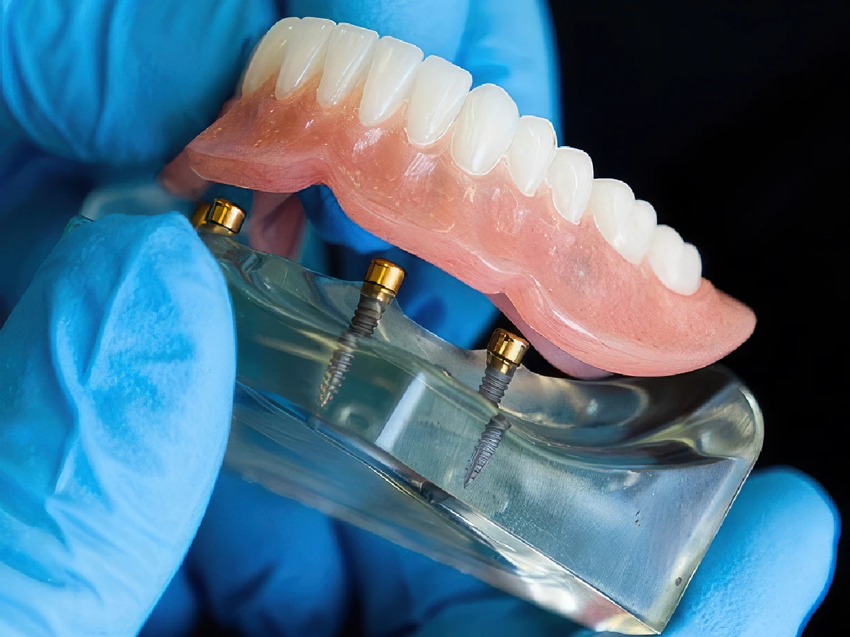 Dental implant dentures at All On Smile Vancouver WA