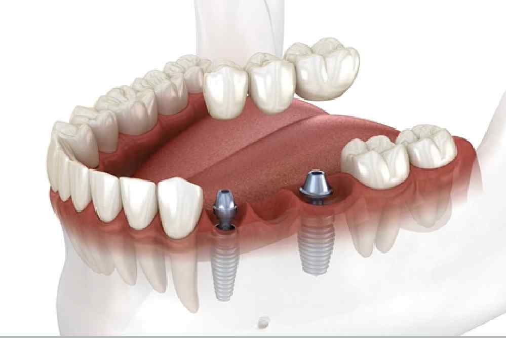 New Project 1 - All On Smile Dental Implants Vancouver WA
