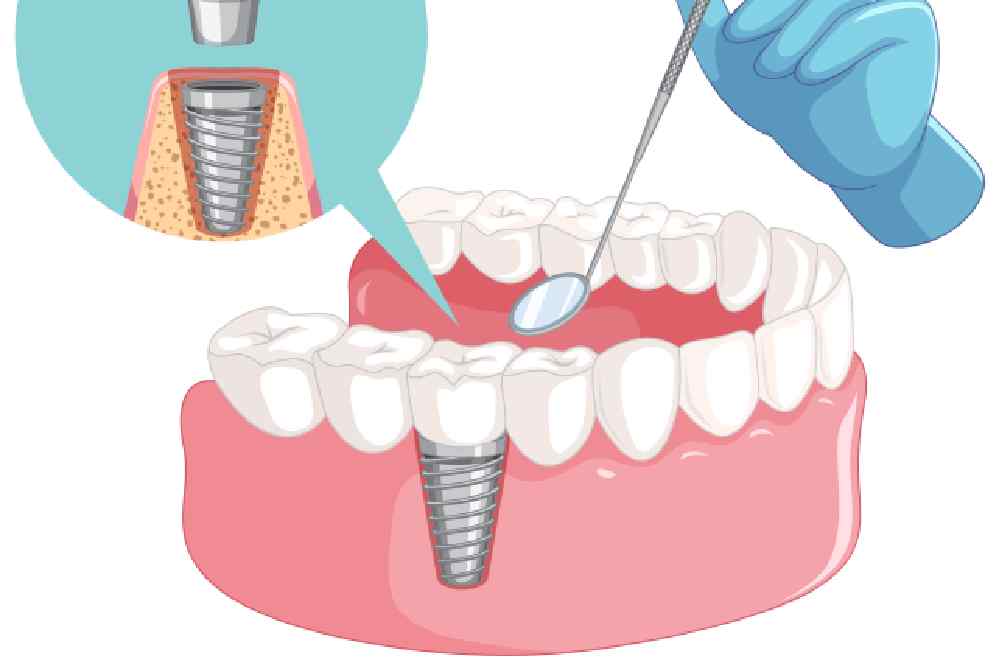New Project 2 - All On Smile Dental Implants Vancouver WA