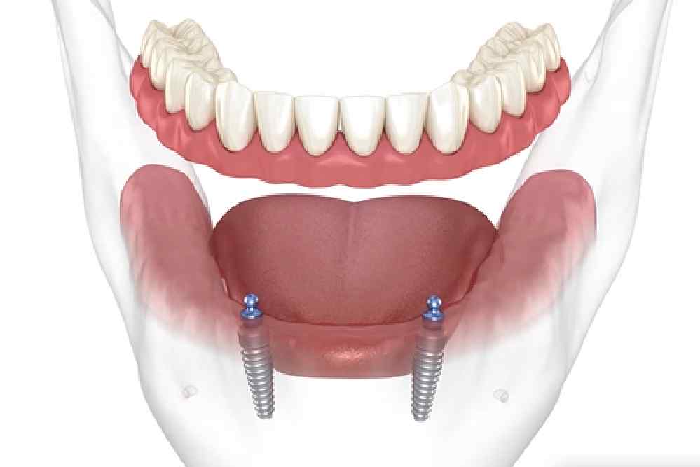 New Project - All On Smile Dental Implants Vancouver WA