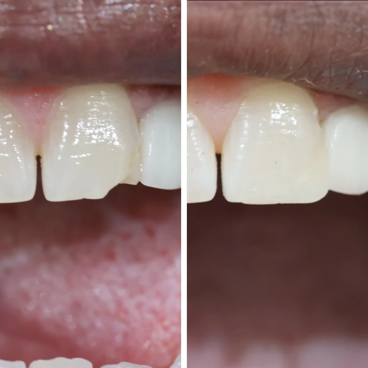 Patient smile transformation at All On Smile Vancouver WA