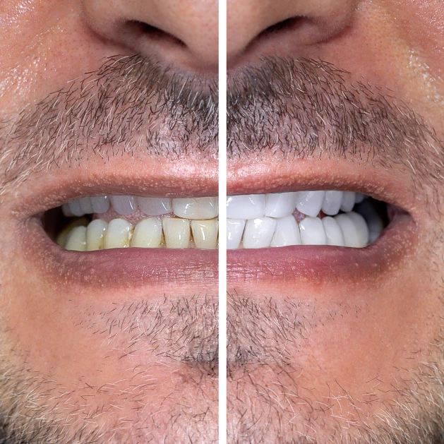 Patient smile transformation at All On Smile Vancouver WA