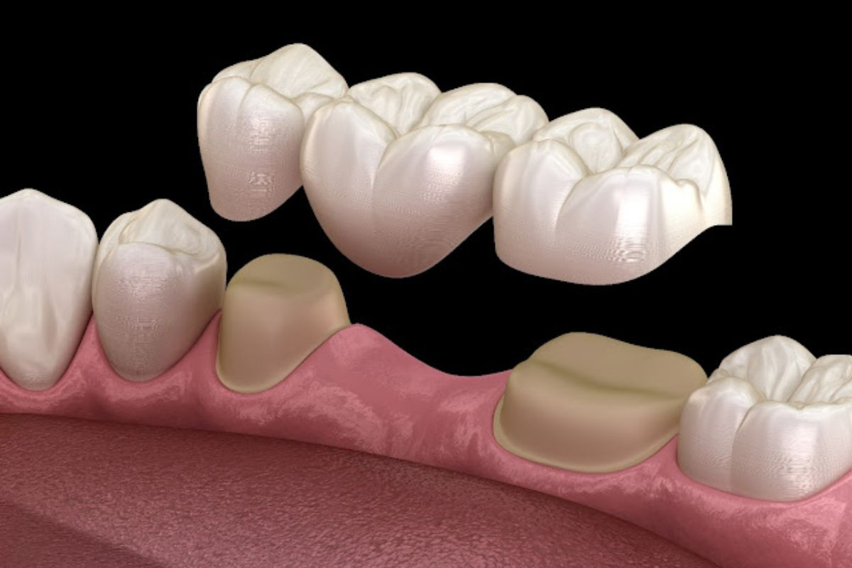 Bridge - All On Smile Dental Implants Vancouver WA