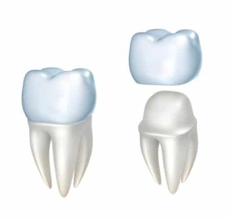 Crown - All On Smile Dental Implants Vancouver WA