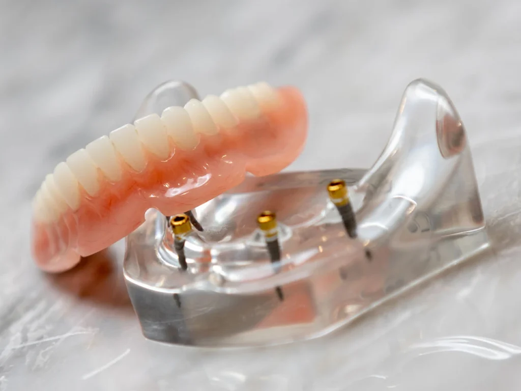Dental implant dentures at All On Smile Vancouver WA
