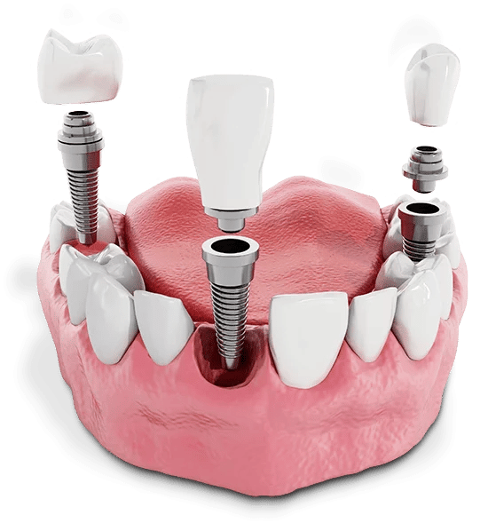 Dental implant procedure at All On Smile Vancouver WA