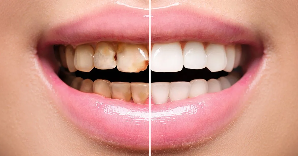 Patient smile transformation at All On Smile Vancouver WA