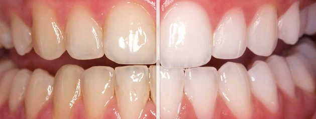 Whitening - All On Smile Dental Implants Vancouver WA